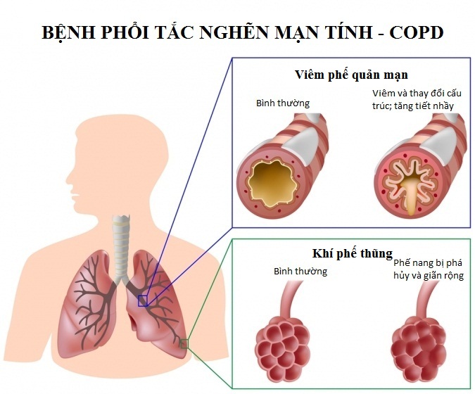 Bệnh phổi tắc nghẽn mạn tính: 16-80% gây tử vong