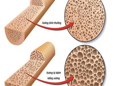 Bệnh loãng xương – Nguyên nhân và cách điều trị