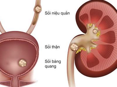 Sỏi tiết niệu và tán sỏi ngoài cơ thể