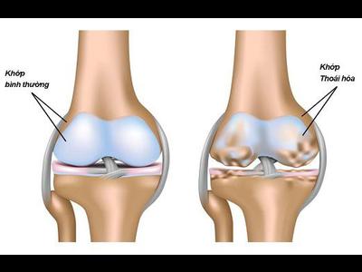 Thoái hóa khớp gối và những điều cần biết