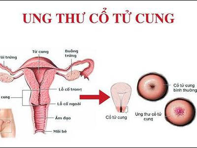 Soi cổ tử cung – Phương pháp phát hiện sớm ung thư cổ tử cung