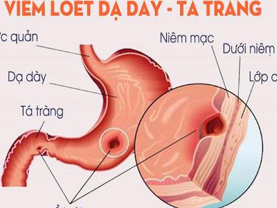 Những điều cần biết về bệnh viêm loét dạ dày tá tràng