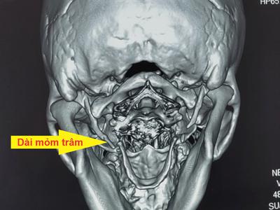 Phẫu thuật thành công trường hợp hiếm gặp cho người phụ nữ bị dài mỏm trâm